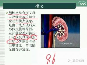 胡桃夹征象为什么会出现？如何诊断胡桃夹征象？胡桃夹征象有哪些表现？