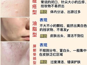 女性长痘痘怎么办？如何找到自己的痘痘？